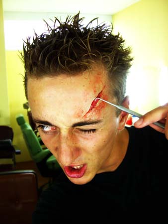 Der Alex und die Wunde!